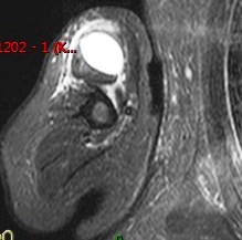 Figure 3 for case amyloid arthropathy ( RID5188 )